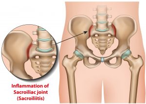 si joint pain amazing life chiropractic