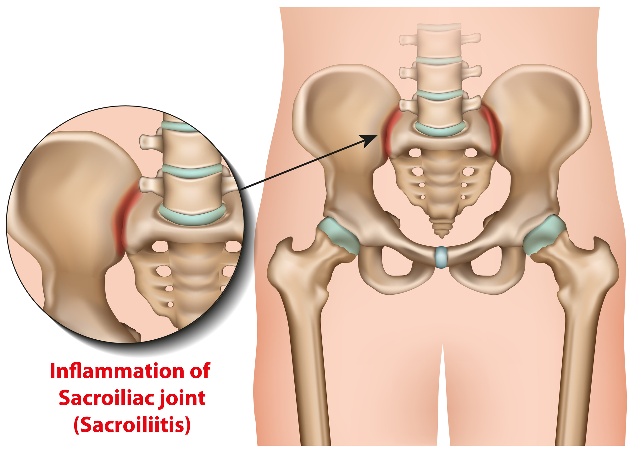 Natural Sacroiliac Joint Treatment in Mill Creek