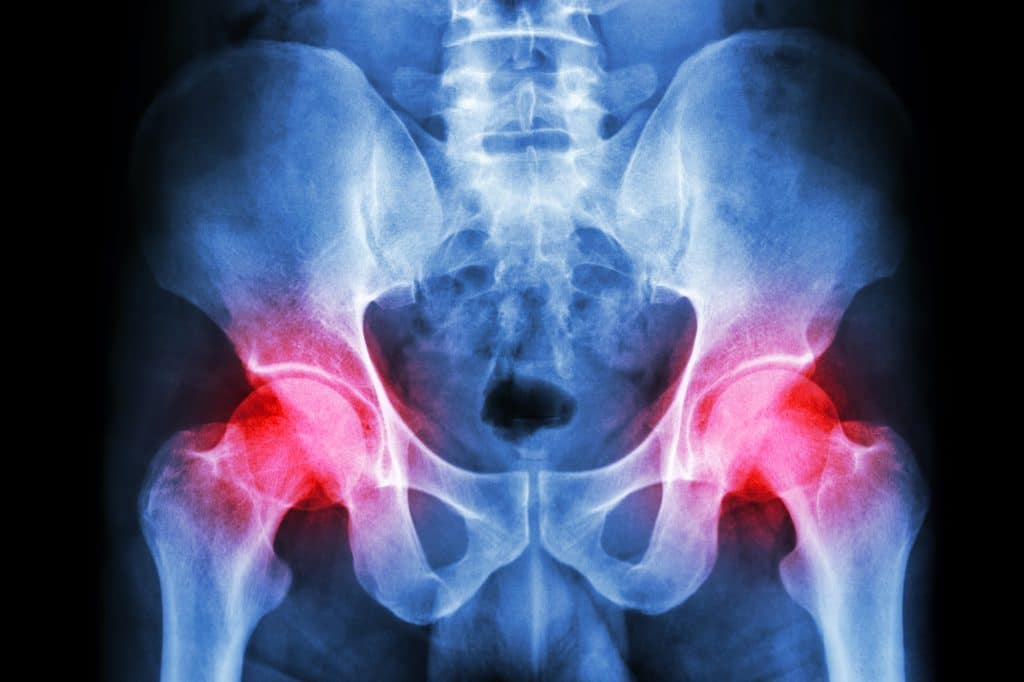 hip pain thumbnail