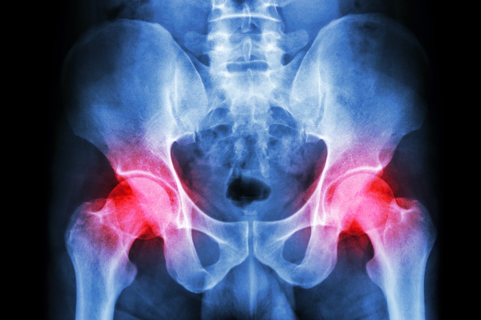 Hip Pain and Custom Orthotics in Mill 