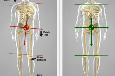 How Custom Orthotics Relieve Pain From Leg Length Discrepancy
