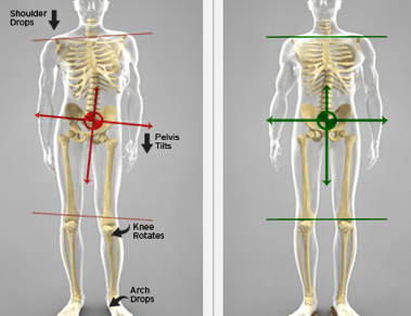 leg length discrepancy amazing lfie chiropractic