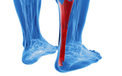 Best Treatment for Achilles Tendonitis?