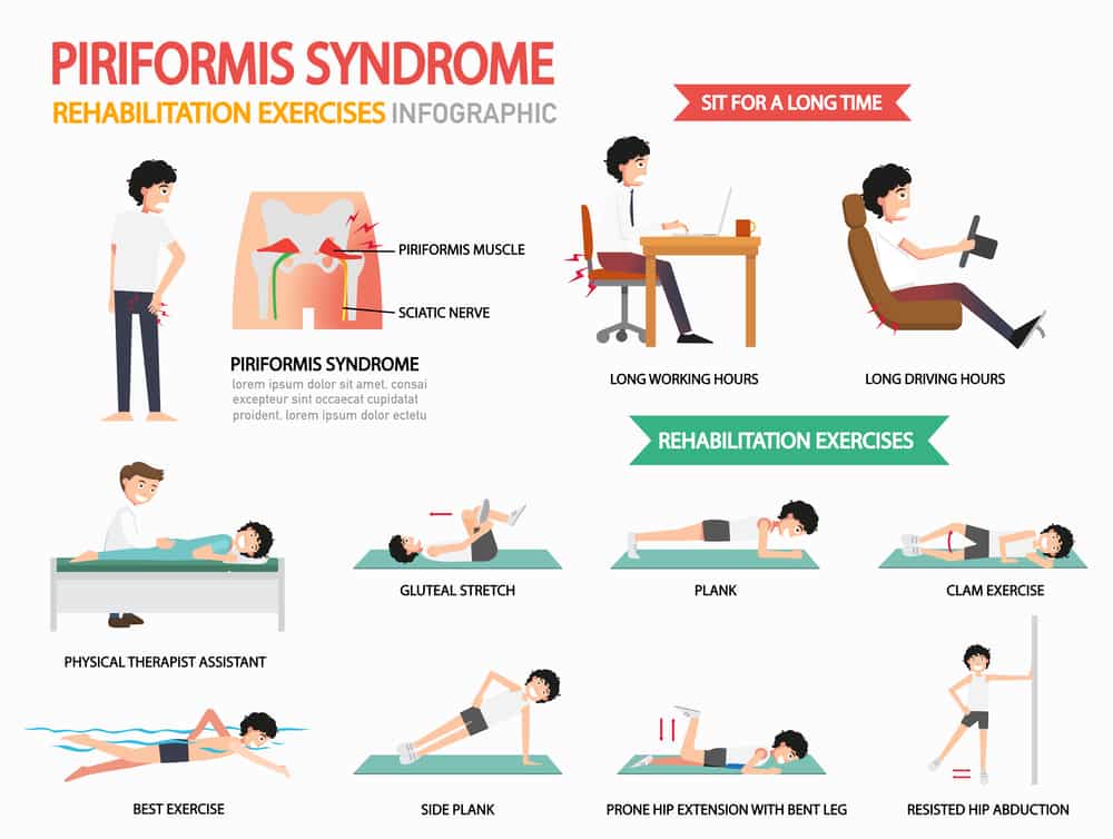 piriformis syndrome