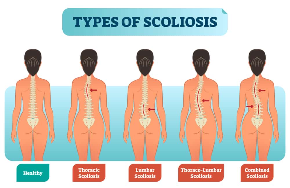 What is scoliosisTypes of scoliosisScoliosis chiropractorHow effective is chiropractic treatment for scoliosis