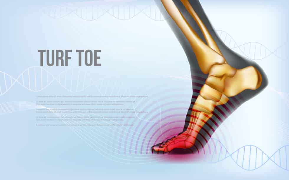 How to Treat Turf Toe Causes, Symptoms, and Expert Treatment Options Amazing Life