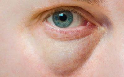 Bags Under Your Eyes – What It Means and How to Fix It