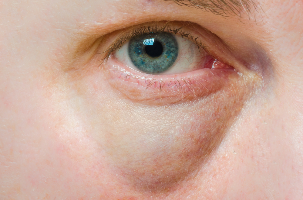 Bags Under Your Eyes – What It Means and How to Fix It