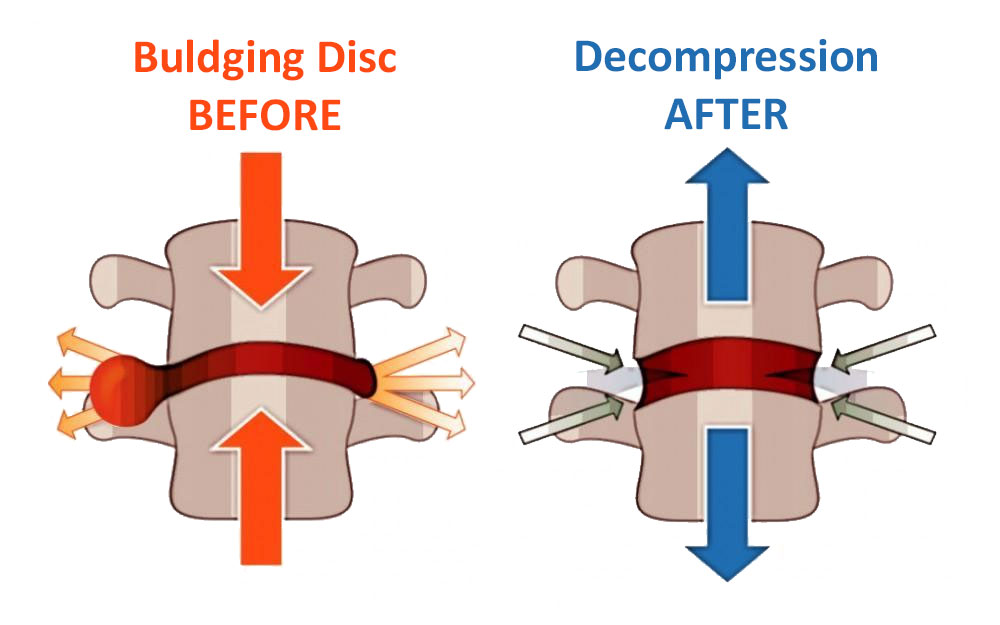Before and After graphic of a backbone disc buldging and with decompression therapy.